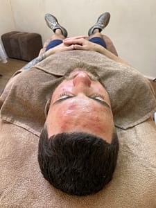 microneedling acnelittekens resultaat huidtherapeut Dermatique