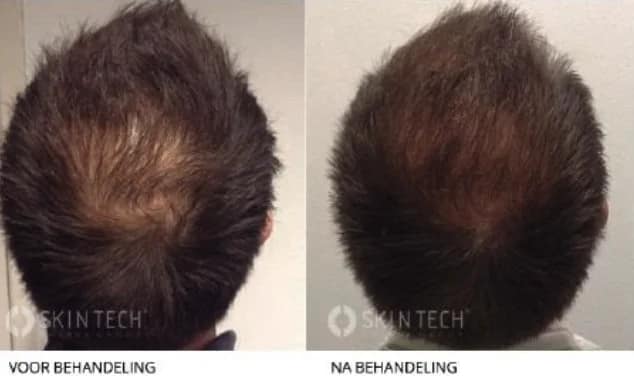 Kruin van een man voor en na behandeling van haaruitval