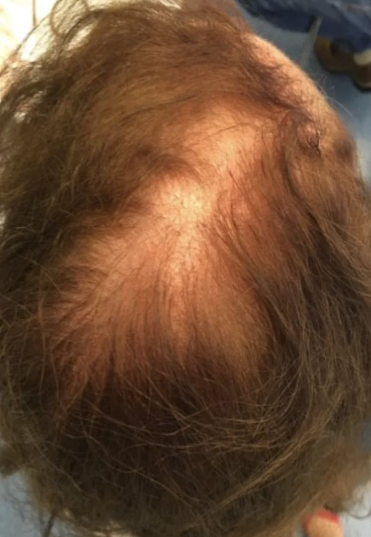 Kruin met zichtbare haaruitval voor de XL Hair-behandeling