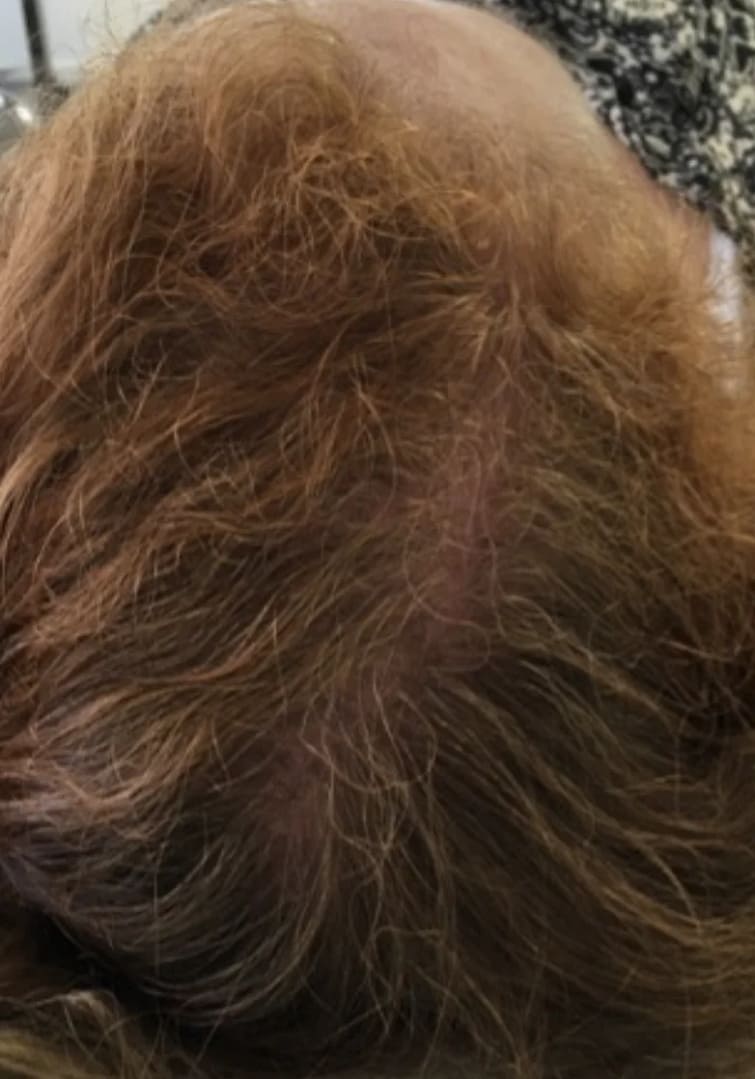 Dezelfde kruin na een XL Hair-traject