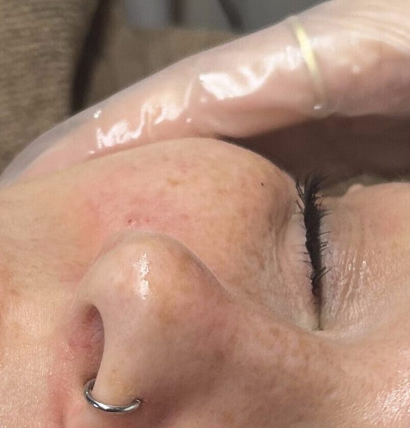 Medische peeling rosacea behandeling Dermatique Badhoevedorp