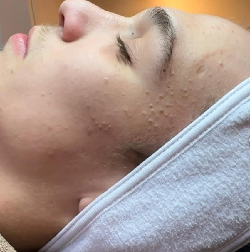 Verschillende vormen van acne: mee-eters, ontstoken puistjes en cysteuze acne op de huid