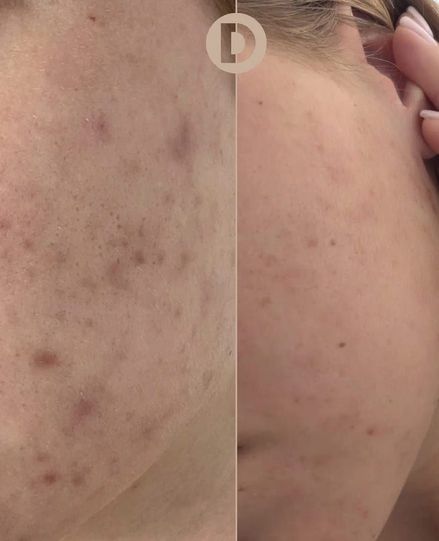 Wang met acne voor en twee weken na één microneedlingbehandeling met PDRN