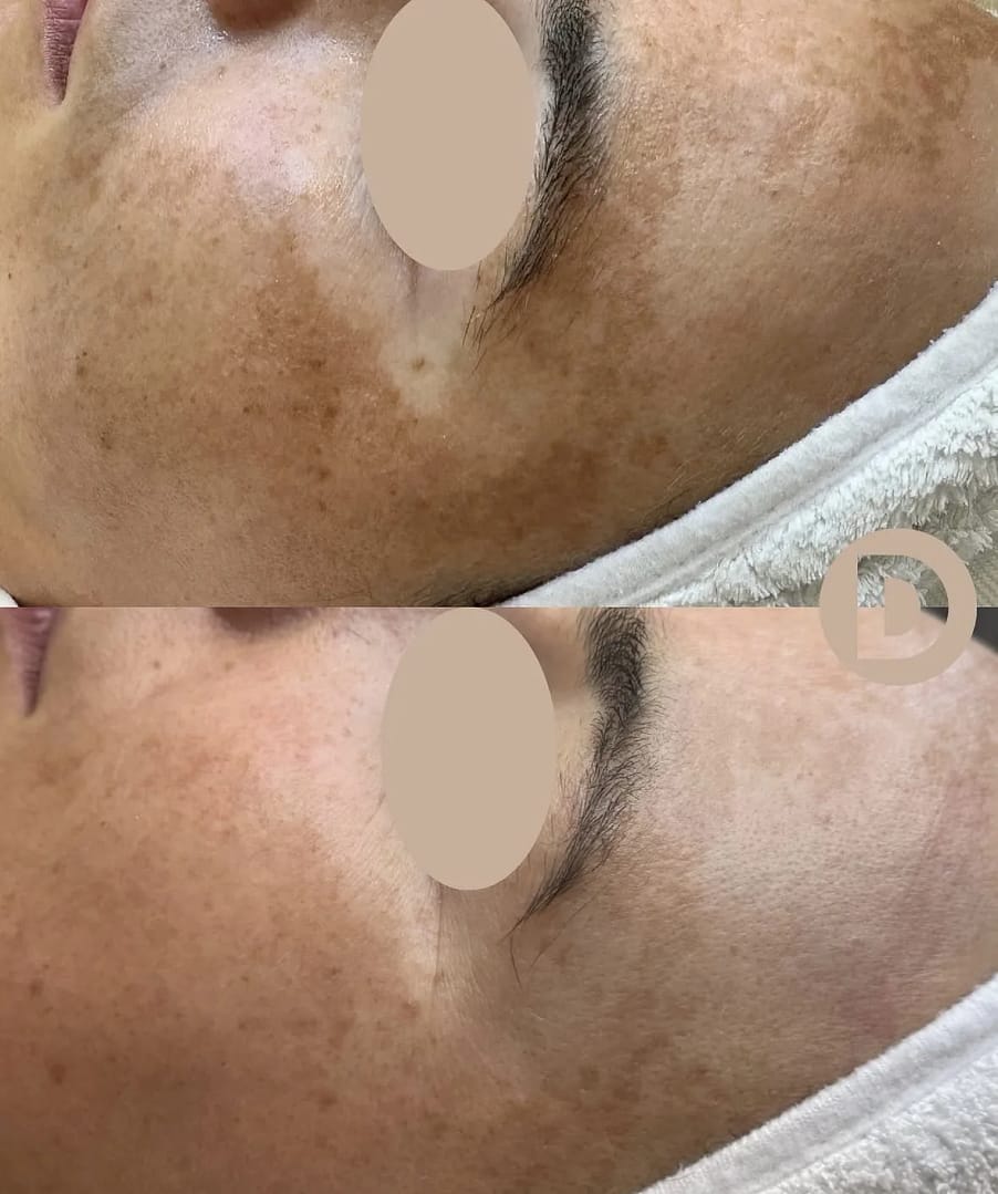 Wang met melasma voor en vier weken na één microneedlingbehandeling